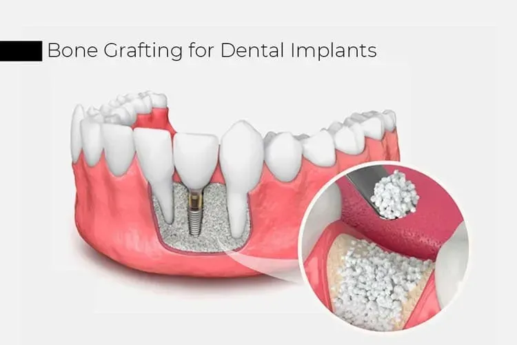 Bone grafting treatment used to build bone volume before implants are placed