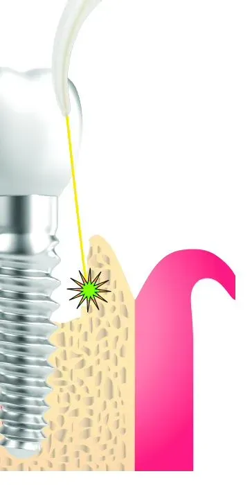 Clinical illustration of gum tissue around a dental implant
