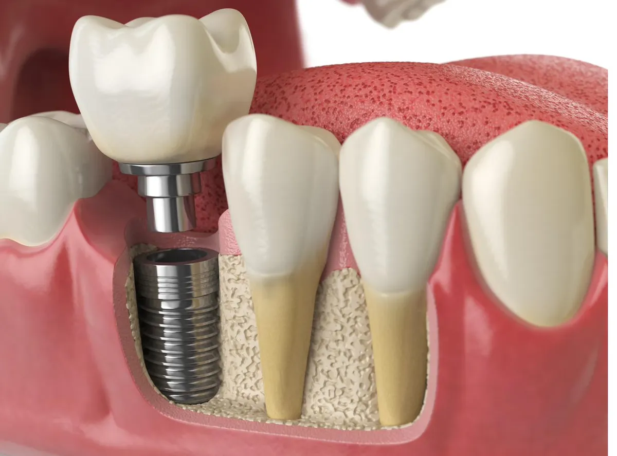 A model showing individual dental implants placed at separate sites
