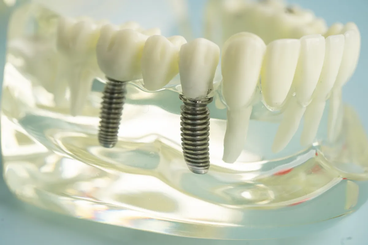 Multiple dental implants supporting a bridge model