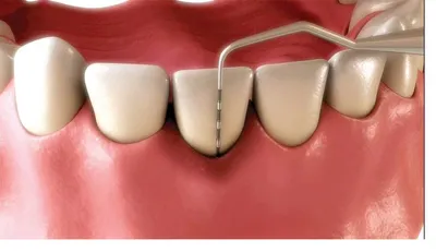 Clinical illustration of a periodontal probe gently measuring gum pocket depth