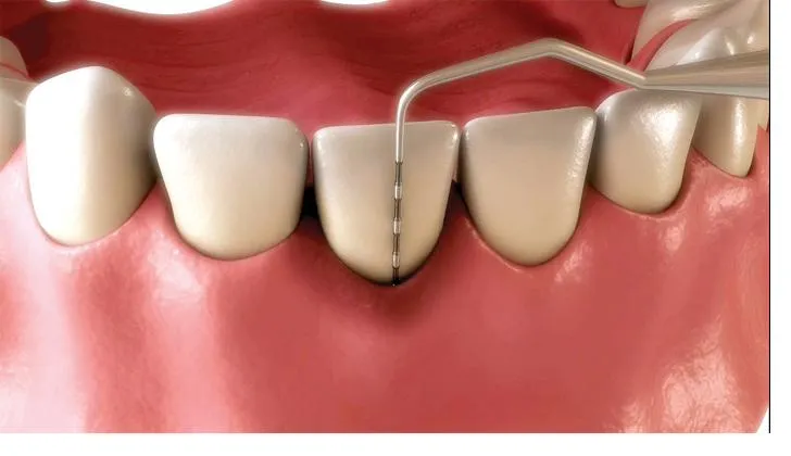 Clinical illustration of a periodontal probe gently measuring gum pocket depth during a scale and clean check-up