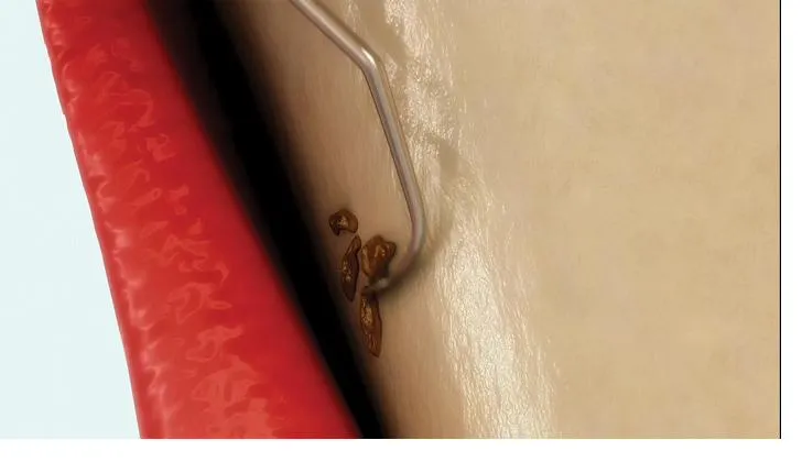 Clinical illustration showing scaling of the tooth root surface during a deep clean (scaling and root planing)