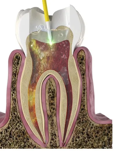 Clinical illustration of laser-assisted root canal treatment, showing a laser tip at the tooth and the canal system inside the root