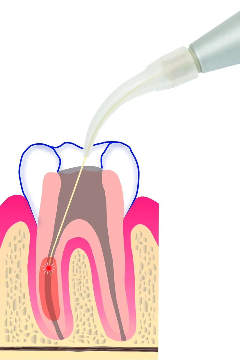 Fotona Nd:YAG laser light applied across a tooth surface — the wavelength used to seal exposed dentinal tubules