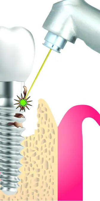Anatomical illustration showing laser energy applied around a dental implant — targeting biofilm in the peri-implant pocket and on the threaded titanium surface