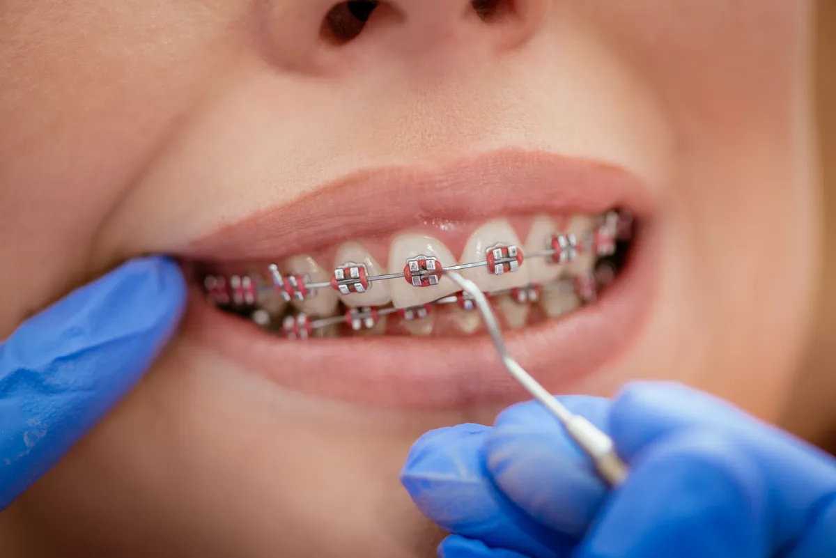Close-up of traditional metal braces brackets and wire