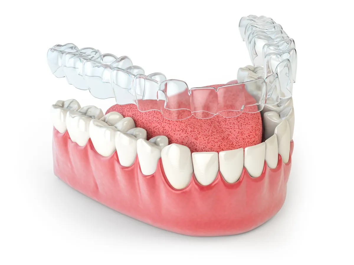 A clear aligner tray fitted over a lower teeth model