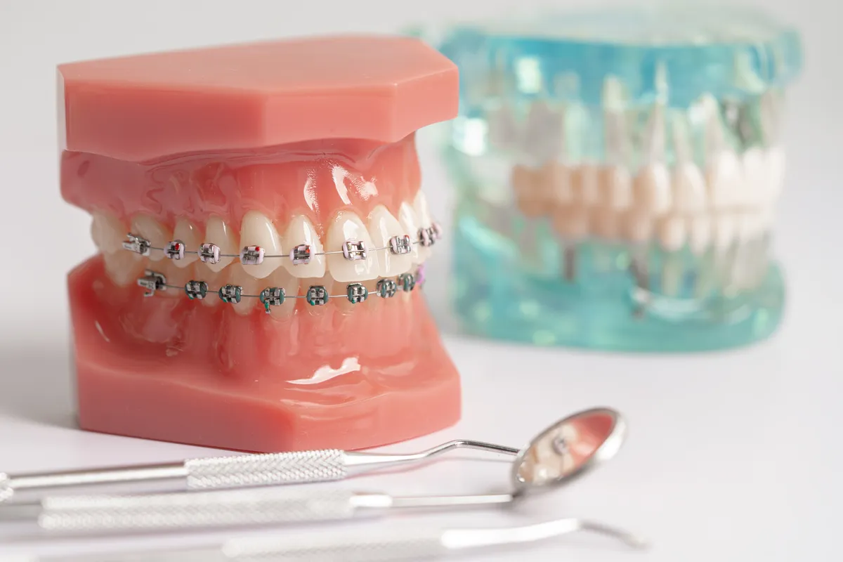 Orthodontic planning tools beside a teeth model